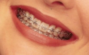 Affordable orthodontics Melbourne